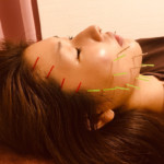 肌質の改善美容鍼SM様