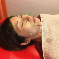 美容鍼顔の引締め効果KS様